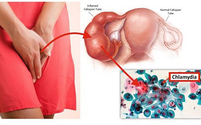 Bệnh Chlamydia: nguyên nhân, dấu hiệu & cách điều trị