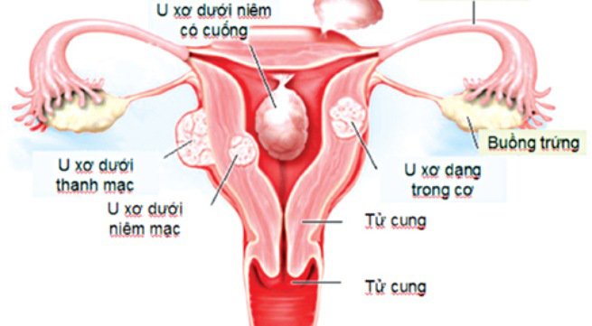 Bệnh u xơ tử cung: dấu hiệu, nguyên nhân và cách chữa dứt điểm