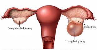 Bệnh u nang buồng trứng: nguyên nhân, dấu hiệu & cách điều trị hiệu quả