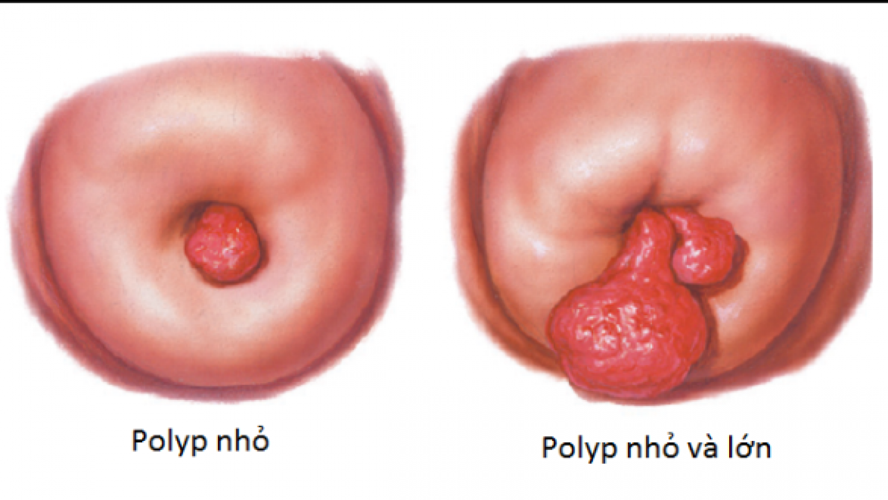 Cách điều trị polyp cổ tử cung hiệu quả