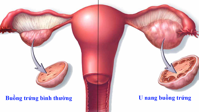 Dấu hiệu u nang buồng trứng và cách chữa hiệu quả