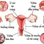 Nhận diện dấu hiệu viêm phụ khoa & địa chỉ khám viêm phụ khoa ở Nam Định