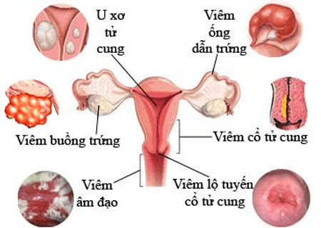Nhận diện dấu hiệu viêm phụ khoa & địa chỉ khám viêm phụ khoa ở Nam Định