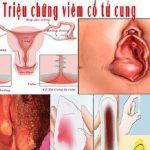 Dấu hiệu viêm cổ tử cung và cách điều trị hiệu quả ở Nam Định