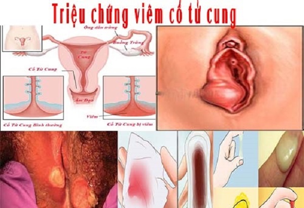 Triệu chứng viêm cổ tử cung ? cách chữa viên cổ tử cung tại Nam Định