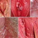 Bệnh sùi mào gà ở nữ giới: nguyên nhân, biến chứng và cách điều trị
