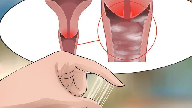 Biểu hiện viêm âm đạo nữ giới nên biết