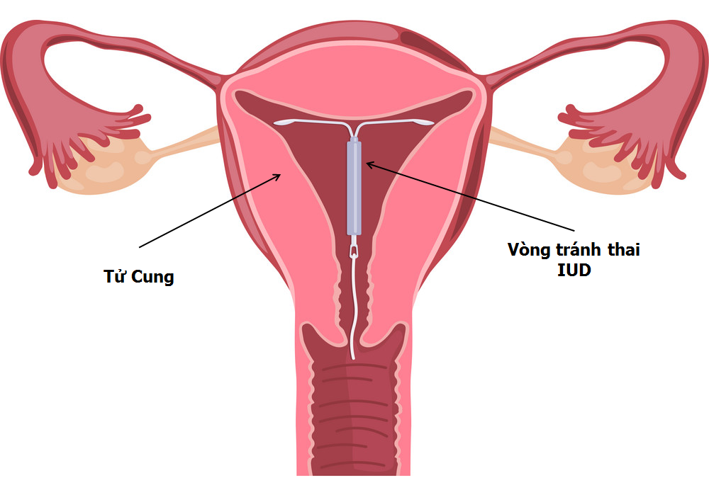 Đặt vòng tránh thai là gì ? quá trình đặt vòng tránh thai thế nào